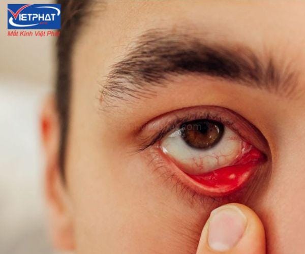 Sạn vôi ở mắt có nguy hiểm không? Cách điều trị và phòng ngừa 6 sạn vôi ở mắt