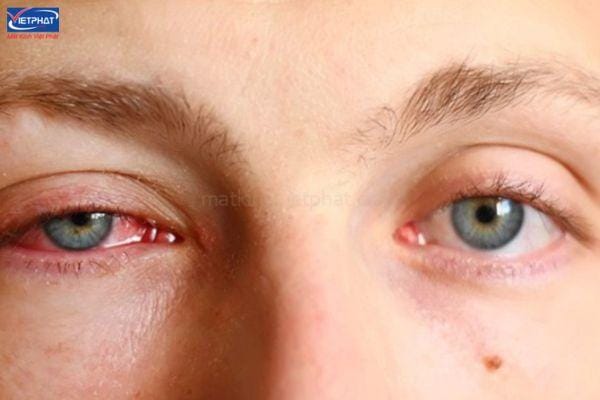 Sạn vôi ở mắt có nguy hiểm không? Cách điều trị và phòng ngừa 7 sạn vôi ở mắt