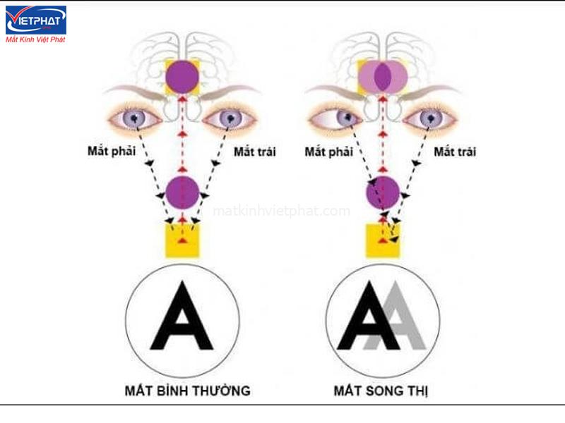 Cách điều trị Song thị - Bệnh nhìn một thành hai 7 Song thị là gì