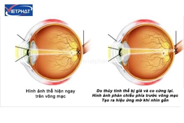 Tại sao người già thường phải đeo kính lão? 6 tại sao người già phải đeo kính lão