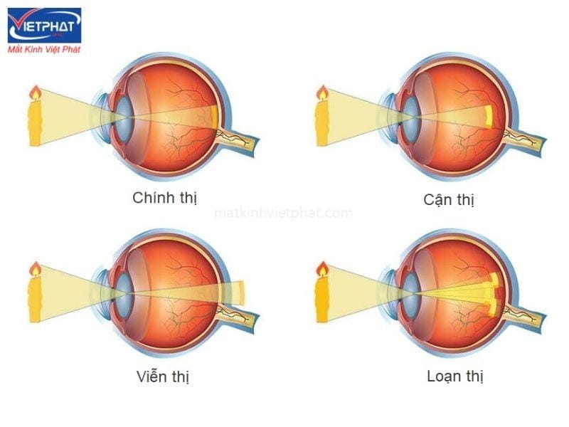 Tật khúc xạ là gì? Các tật khúc xạ thường gặp 9 Tật khúc xạ ở mắt
