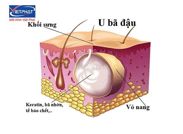 U bã đậu ở mi mắt có nguy hiểm không? Cách điều trị u bã đậu ở mi mắt 7 u bã đậu ở mi mắt