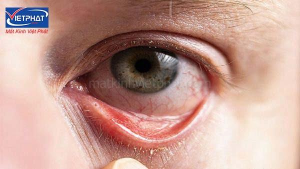 U bã đậu ở mi mắt có nguy hiểm không? Cách điều trị u bã đậu ở mi mắt 9 u bã đậu ở mi mắt