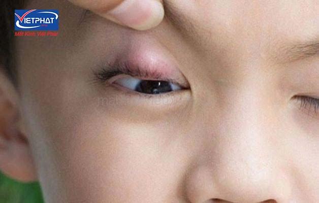 U bã đậu ở mi mắt có nguy hiểm không? Cách điều trị u bã đậu ở mi mắt 10 u bã đậu ở mi mắt