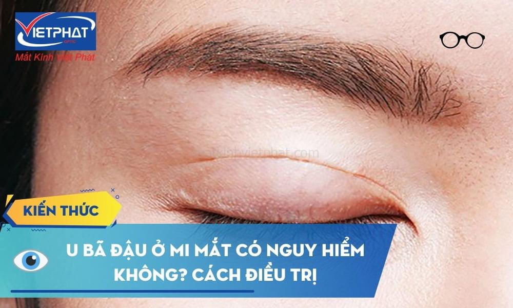 U bã đậu ở mi mắt có nguy hiểm không? Cách điều trị u bã đậu ở mi mắt 6 U bã đậu ở mi mắt có nguy hiểm không? Cách điều trị u bã đậu ở mi mắt