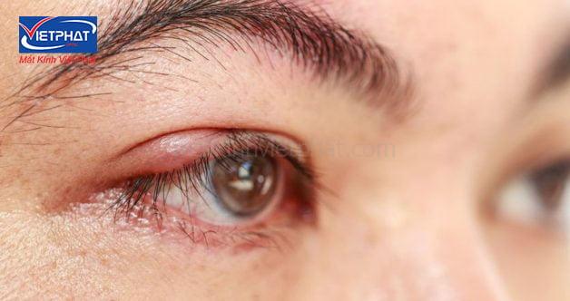 U bã đậu ở mi mắt có nguy hiểm không? Cách điều trị u bã đậu ở mi mắt 11 u bã đậu ở mi mắt