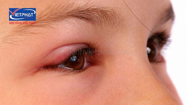 U bã đậu ở mi mắt có nguy hiểm không? Cách điều trị u bã đậu ở mi mắt 8 u bã đậu ở mi mắt