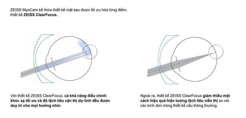 Tròng kính quản lý tiến triển cận thị trẻ em ZEISS MyoCare 27 Thiết kế ZEISS ClearFocus
