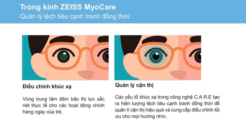 Tròng kính quản lý tiến triển cận thị trẻ em ZEISS MyoCare 24 Tròng kính quản lý tiến triển cận thị trẻ em ZEISS MyoCare