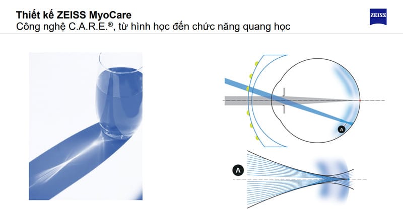 Tròng kính quản lý tiến triển cận thị trẻ em ZEISS MyoCare 26 Công nghệ C.A.R.E